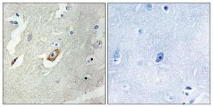 Immunohistochemical analysis of paraffin-embedded human breast carcinoma tissue using Anti-CDC16 Antibody. The right hand panel represents a negative control, where the antibody was pre-incubated with the immunising peptide.