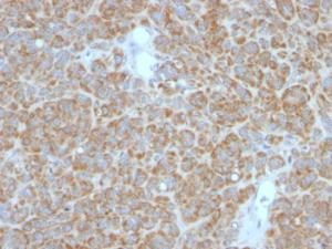 Immunohistochemical analysis of formalin-fixed, paraffin-embedded human melanoma using Anti-Bcl-2 Antibody [BCL2/782 + BCL2/796]