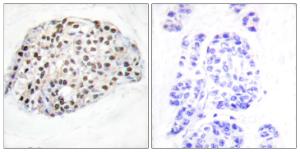 Immunohistochemical analysis of paraffin-embedded human breast carcinoma tissue using Anti-HDAC1 Antibody. The right hand panel represents a negative control, where the antibody was pre-incubated with the immunising peptide