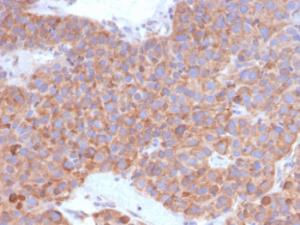 Immunohistochemical analysis of formalin-fixed, paraffin-embedded human liver carcinoma in colon using Anti-B7-H6 Antibody [B7H6/4821]