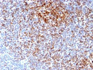 Immunohistochemical analysis of formalin-fixed, paraffin-embedded human follicular lymphoma using Anti-Bcl-2 Antibody [BCL2/2210R]