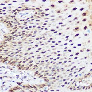 Immunohistochemistry analysis of paraffin-embedded human esophageal using Anti-SOX2 Antibody (A11928) at a dilution of 1:100 (40x lens). Perform microwave antigen retrieval with 10 mM Tris/EDTA buffer pH 9.0 before commencing with IHC staining protocol.