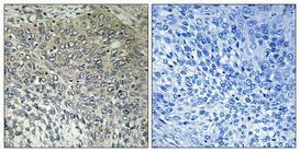 Immunohistochemical analysis of paraffin-embedded human cervix cancer using Anti-FAKD3 Antibody 1:100 (4°C overnight) The right hand panel represents a negative control, where the antibody was pre-incubated with the immunising peptide