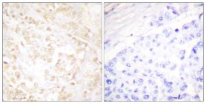 Immunohistochemical analysis of paraffin-embedded human breast carcinoma tissue using Anti-XRCC6 Antibody. The right hand panel represents a negative control, where the antibody was pre-incubated with the immunising peptide