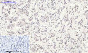 Immunohistochemical analysis of paraffin-embedded human liver cancer tissue using Anti-GLUT1 Antibody at 1:200 (4 °C overnight). Negative control was secondary Antibody only