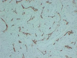 Immunohistochemical analysis of paraffin-embedded human Renal clear cell carcinoma using Anti-CD105 Antibody