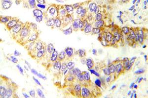 Immunohistochemical analysis of paraffin-embedded human lung carcinoma tissue using Anti-Tsc2 Antibody