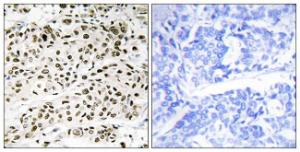 Immunohistochemical analysis of paraffin-embedded human breast carcinoma tissue using Anti-VPS72 Antibody. The right hand panel represents a negative control, where the Antibody was pre-incubated with the immunising peptide