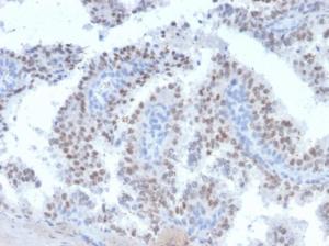 Immunohistochemical analysis of formalin-fixed, paraffin-embedded human prostate carcinoma using Anti-RET Antibody [RET/2663]