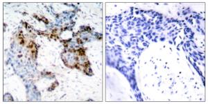 Immunohistochemical analysis of paraffin-embedded human breast carcinoma tissue using Anti-Estrogen Receptor-alpha Antibody. The right hand panel represents a negative control, where the antibody was pre-incubated with the immunising peptide.