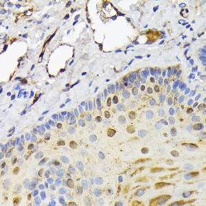 Immunohistochemistry analysis of paraffin-embedded human esophageal cancer using Anti-FABP5 Antibody (A11968) at a dilution of 1:200 (40X lens). Perform high pressure antigen retrieval with 10 mM citrate buffer pH 6.0 before commencing with IHC staining protocol