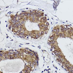 Immunohistochemistry analysis of paraffin-embedded human breast cancer tissue using Anti-MGST1 Antibody [ARC2550] (A307955) at a dilution of 1:100 (40x lens)