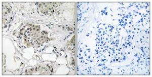 Immunohistochemical analysis of paraffin-embedded human breast carcinoma tissue using Anti-USP13 Antibody. The right hand panel represents a negative control, where the antibody was pre-incubated with the immunising peptide.