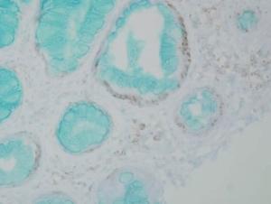 Immunohistochemistry analysis of human colon carcinoma, fixed in formalin