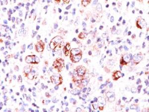 Immunohistochemical analysis of formalin-fixed, paraffin-embedded Hodgkin's lymphoma using Anti-Bcl-X Antibody [2H12]