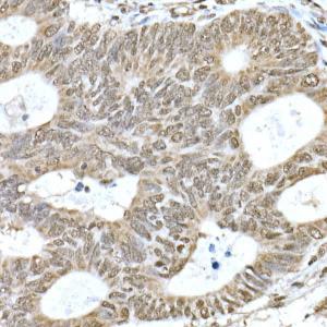 Immunohistochemistry analysis of paraffin-embedded human colon carcinoma tissue using Anti-PI3 Kinase p110 beta Antibody [ARC0703] (A309440) at a dilution of 1:20(40X lens). Perform high pressure antigen retrieval with 10 mM citrate buffer pH 6.0 before commencing with IHC staining protocol