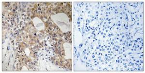 Immunohistochemical analysis of paraffin-embedded human breast carcinoma using Anti-SPHK2 (phospho Thr614) Antibody. The right hand panel represents a negative control, where the antibody was pre-incubated with the immunising peptide