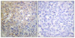 Immunohistochemical analysis of paraffin-embedded human breast carcinoma tissue using Anti-FGFR1 Antibody. The right hand panel represents a negative control, where the antibody was pre-incubated with the immunising peptide.