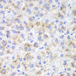 Immunohistochemistry analysis of paraffin-embedded human liver cancer using Anti-HAO1/GOX Antibody (A11977) at a dilution of 1:200 (40x lens) Perform microwave antigen retrieval with 10 mM PBS buffer pH 72 before commencing with IHC staining protocol