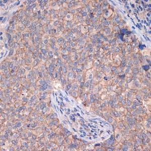 Immunohistochemistry analysis of paraffin-embedded human breast cancer tissue using Anti-CTNNA3 Antibody [ARC2463] (A305581) at a dilution of 1:100 (40X lens). Perform microwave antigen retrieval with 10 mM Tris/EDTA buffer pH 9.0 before commencing with IHC staining protocol