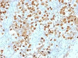 Immunohistochemical analysis of formalin-fixed, paraffin-embedded human breast carcinoma using Anti-ZMYM3 Antibody [PCRP-ZMYM3-2F10]