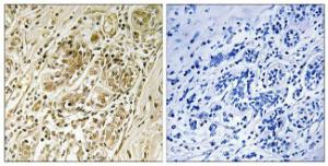 Immunohistochemical analysis of paraffin-embedded human breast carcinoma using Anti-IRS-1 (phospho Ser639) Antibody. The right hand panel represents a negative control, where the antibody was pre-incubated with the immunising peptide