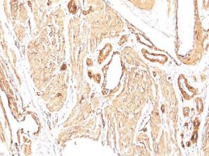 Immunohistochemical analysis of formalin-fixed, paraffin-embedded human leiomyosarcoma using Anti-alpha Smooth Muscle Actin Antibody [1A4]