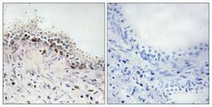 Immunohistochemical analysis of paraffin-embedded human prostate cancer using Anti-DNA Ligase 4 Antibody 1:100 (4°C overnight). The right hand panel represents a negative control, where the antibody was pre-incubated with the immunising peptide.