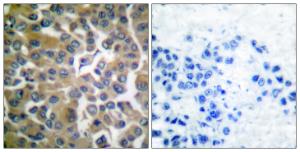 Immunohistochemical analysis of paraffin-embedded human breast carcinoma tissue using Anti-FAP-1 Antibody The right hand panel represents a negative control, where the antibody was pre-incubated with the immunising peptide