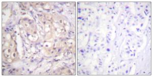 Immunohistochemical analysis of paraffin-embedded human breast carcinoma using Anti-B-RAF (phospho Thr599) Antibody. The right hand panel represents a negative control, where the antibody was pre-incubated with the immunising peptide