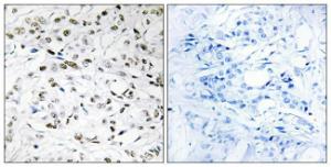 Immunohistochemical analysis of paraffin-embedded human breast carcinoma using Anti-ELOA1 Antibody. The right hand panel represents a negative control, where the Antibody was pre-incubated with the immunising peptide