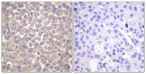 Immunohistochemical analysis of paraffin-embedded human breast carcinoma tissue using Anti-TRADD Antibody. The right hand panel represents a negative control, where the Antibody was pre-incubated with the immunising peptide