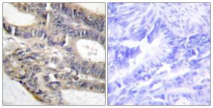 Immunohistochemical analysis of paraffin-embedded human colon carcinoma tissue using Anti-AS250 Antibody. The right hand panel represents a negative control, where the Antibody was pre-incubated with the immunising peptide