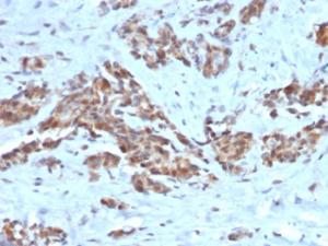 Immunohistochemical analysis of formalin-fixed, paraffin-embedded human breast using Anti-ARF1 Antibody [ARF1/2117]