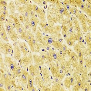 Immunohistochemistry analysis of paraffin-embedded human liver damage using Anti-TXNL1 Antibody (A307964) at a dilution of 1:100 (40x lens). Perform microwave antigen retrieval with 10 mM PBS buffer pH 7.2 before commencing with IHC staining protocol.