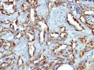 Immunohistochemical analysis of formalin-fixed, paraffin-embedded human angiosarcoma tissue using Anti-CD31 Antibody [C31.3 + JC/70A]