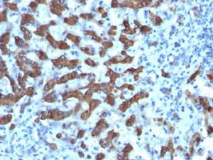 Immunohistochemical analysis of formalin-fixed, paraffin-embedded human hepatocellular cancer using Anti-CPS1 Antibody [CPS1/1022]