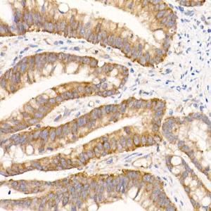 Immunohistochemistry analysis of paraffin-embedded human colon carcinoma tissue using Anti-eIF1A Antibody [ARC2941] (A306703) at a dilution of 1:50 (40X lens). Perform high pressure antigen retrieval with 10 mM citrate buffer pH 6.0 before commencing with IHC staining protocol