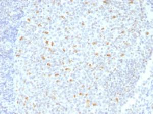 Immunohistochemical analysis of formalin-fixed, paraffin-embedded human Hodgkin's lymphoma using Anti-Bcl-6 Antibody [BCL6/1526]