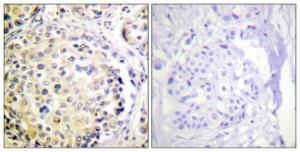 Immunohistochemical analysis of paraffin-embedded human breast carcinoma tissue using Anti-Vimentin Antibody. The right hand panel represents a negative control, where the antibody was pre-incubated with the immunising peptide