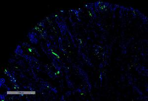 Immunohistochemistry analysis of human thyroid cancer