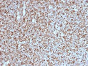 Immunohistochemical analysis of formalin-fixed, paraffin-embedded human follicular lymphoma using Anti-Bcl-6 Antibody [BCL6/1527]