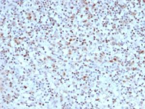 Immunohistochemical analysis of formalin-fixed, paraffin-embedded human Hodgkin's lymphoma using Anti-Bcl-6 Antibody [BCL6/1527]