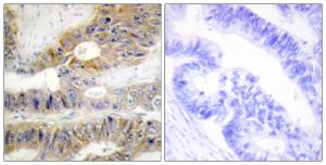 Immunohistochemical analysis of paraffin-embedded human colon carcinoma tissue using Anti-TNFRSF6B Antibody. The right hand panel represents a negative control, where the antibody was pre-incubated with the immunising peptide