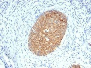 Immunohistochemical analysis of formalin-fixed, paraffin-embedded human cervical squamous cell carcinoma using Anti-Maspin Antibody [SERPINB5/4975]