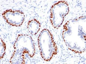 Immunohistochemical analysis of formalin-fixed, paraffin-embedded human prostate cancer using Anti-p63 Antibody [TP63/1423R]