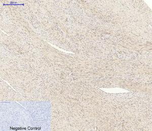 Immunohistochemical analysis of paraffin-embedded human uterus cancer tissue using Anti-AKT1 + AKT2 + AKT3 Antibody at 1:200 (4°C overnight) Negative control was secondary antibody only