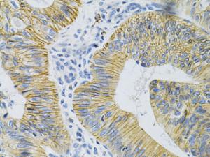 Immunohistochemistry analysis of paraffin-embedded human colon carcinoma tissue using Anti-N Cadherin Antibody (A305590) at a dilution of 1:100 (40X lens). Perform microwave antigen retrieval with 10 mM PBS buffer pH 7.2 before commencing with IHC staining protocol