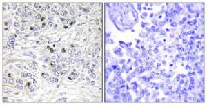 Immunohistochemical analysis of paraffin-embedded human breast carcinoma tissue using Anti-TEAD2 Antibody The right hand panel represents a negative control, where the antibody was pre-incubated with the immunising peptide