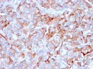 Immunohistochemical analysis of formalin-fixed, paraffin-embedded human gastric carcinoma using Anti-BCMA Antibody [BCMA/2366]